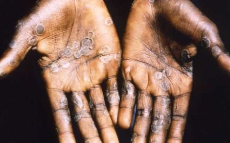Ghana Confirms Third Mpox Case in Accra, Health Authorities Intensify Response