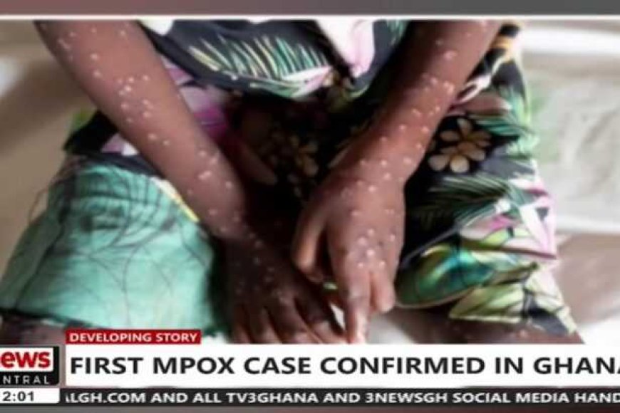Ghana Health Service confirms two new Mpox cases, total now four in Ghana