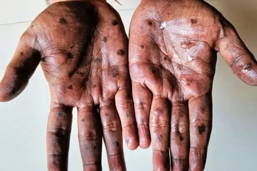 Ghana Confirms 26 New Mpox Cases, Total Now 45 as Surveillance Intensifies